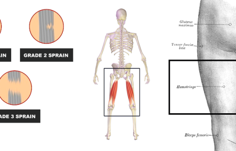 Hamstring Injury: Your Questions Answered