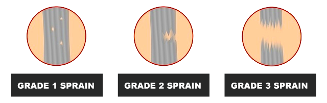 Degrees Of Calf Strain